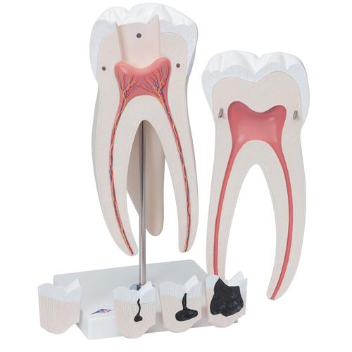 Giant Molar with Dental Cavities Human Tooth Model, 15 times Life-Size, 6 part