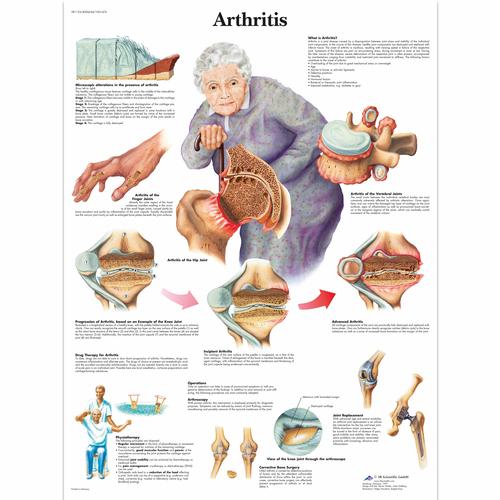Anatomisk planche: Artritis (ledbetændelse), papir
