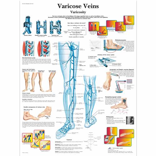 Anatomisk planche: Åreknuder, lamineret