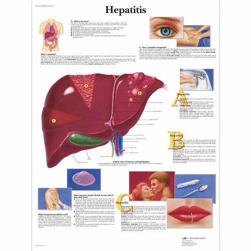 Anatomisk planche: Hepatitis (leverbetændelse), lamineret