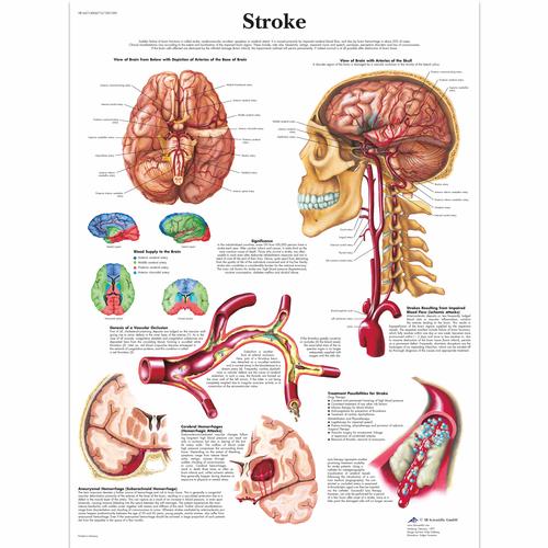 Anatomisk planche: Apopleksi (slagtilfælde), lamineret