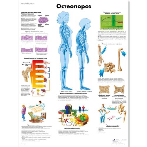 Anatomisk planche: Knogleskørhed (osteoporose), lamineret med metaløjer