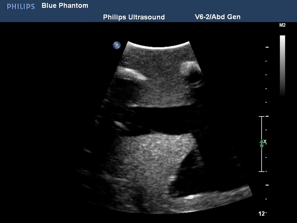 BluePhantom ersättningsvävnad för thorakocentes ultraljudsträningsmodell