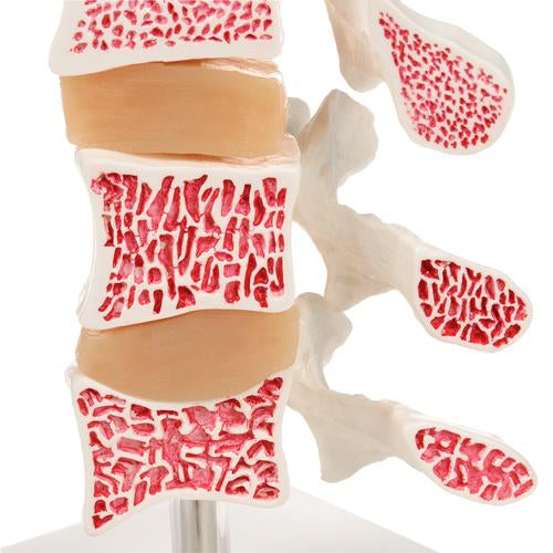 Osteoporosemodel Deluxe (3 hvirvler med diske), aftagelig på stativ – billede 5