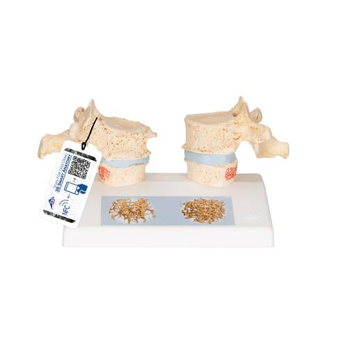 Didaktisk osteoporosemodel