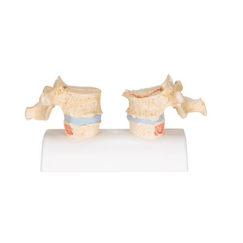 Didaktisk osteoporosemodel – billede 4