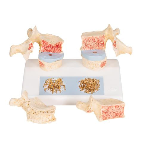 Didaktisk osteoporosemodel – billede 6