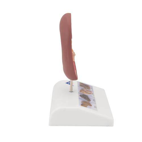 Nyrestensmodel – billede 3