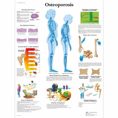 Anatomisk planche: Knogleskørhed (osteoporose), papir