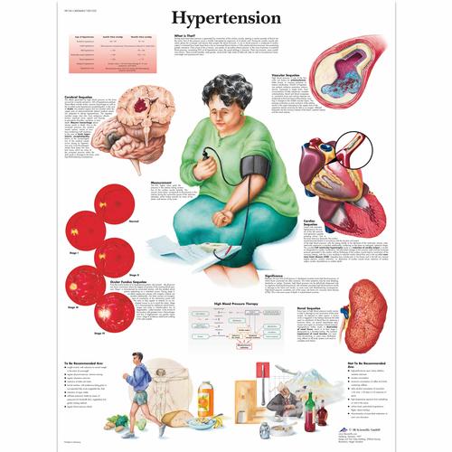 Anatomisk planche: Forhøjet blodtryk (hypertension), papir