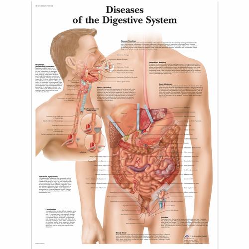 Anatomisk planche: Fordøjelsessygdomme, lamineret