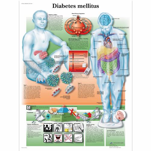 Anatomisk planche: Diabetes (sukkersyge), lamineret