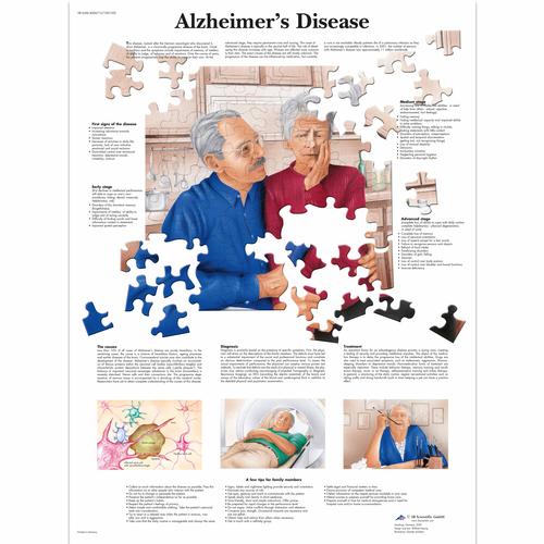 Anatomisk planche: Alzheimers sygdom, papir