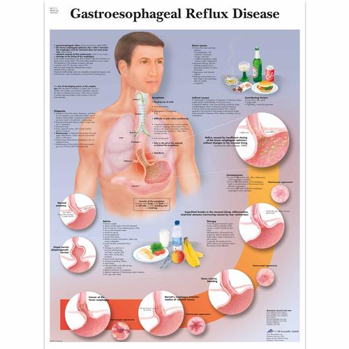 Anatomisk planche: Sur reflux og halsbrand (GERD), papir