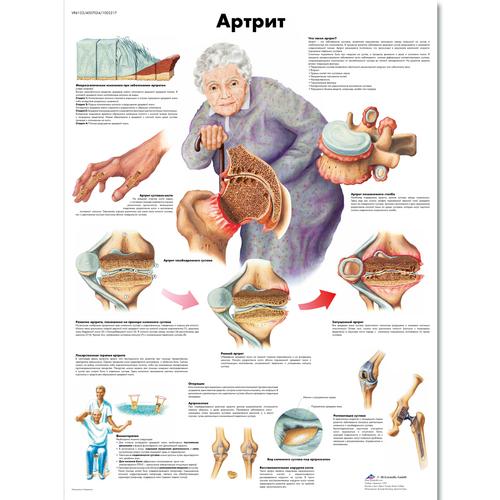 Anatomisk planche: Artritis (ledbetændelse), lamineret med metaløjer