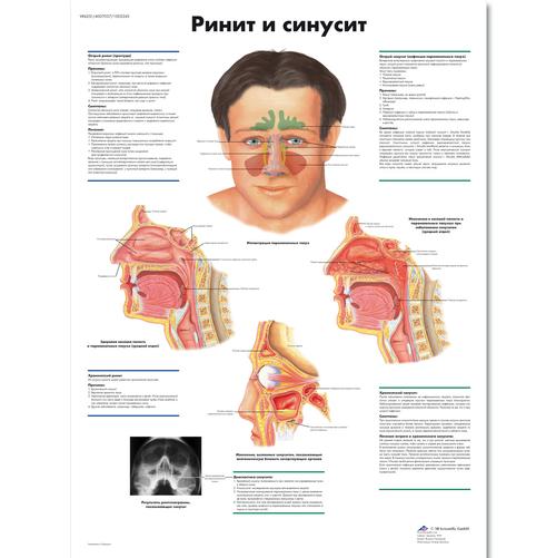 Anatomisk planche: Rhinitis og bihulebetændelse, lamineret med metaløjer