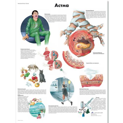 Anatomisk planche: Astma, lamineret med metaløjer