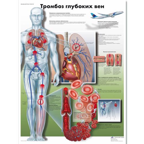 Anatomisk planche: Dyb venetrombose (blodprop i benet), lamineret med metaløjer
