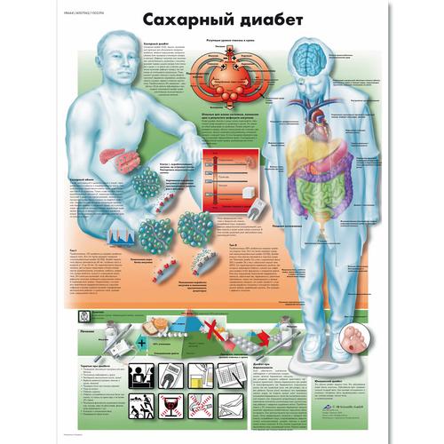Anatomisk planche: Diabetes (sukkersyge), lamineret med metaløjer