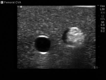 BluePhantom ersättningsvävnad för femoral kärlåtkomst