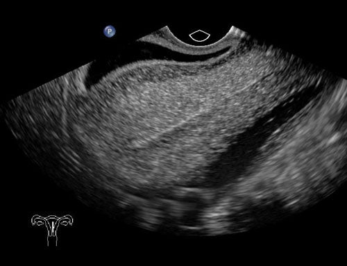 BluePhantom transvaginal ultraljudsträningsmodell för sonohysterografi och sonosalpingografi