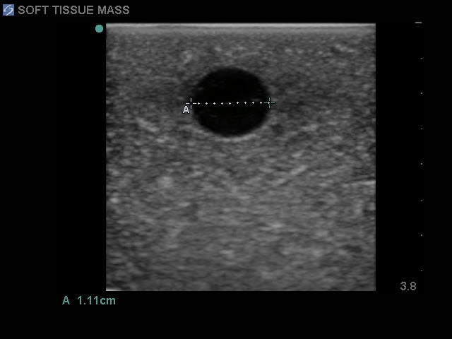 BluePhantom bröstphantom för ultraljudselastografi