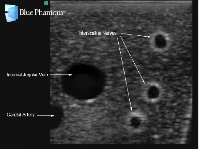Blue Phantom Plexus brachialis-blockad samt ultraljudsvägledd CVK-inläggning med insättning av ersättningsvävnad