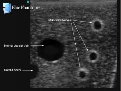 Blue Phantom Plexus brachialis-blockad samt ultraljudsvägledd CVK-inläggning med insättning av ersättningsvävnad