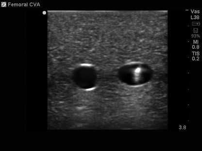 BluePhantom ersättningsvävnad för femoral kärlåtkomst