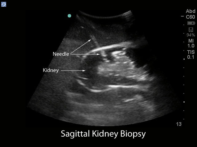 Blue Phantom Ersättningsnjure för ultraljudsguidad renal biopsi träningsmodell