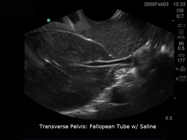 BluePhantom transvaginal ultraljudsträningsmodell för sonohysterografi och sonosalpingografi