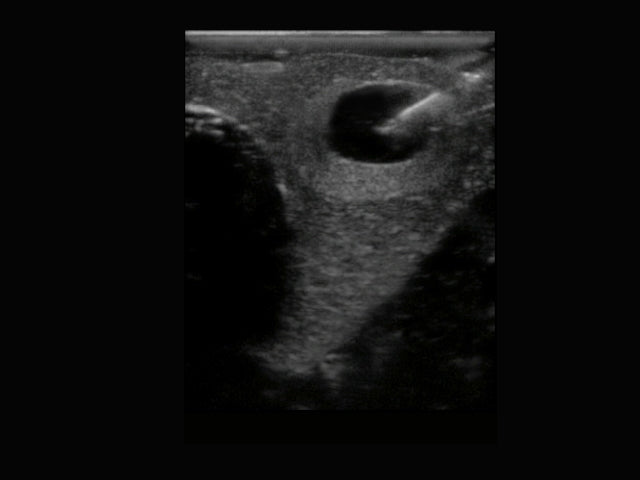 BluePhantom ultraljudsträningsmodell för tyreoideabiopsi