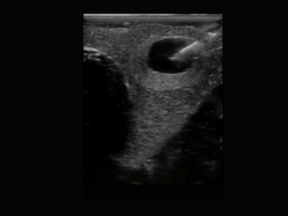 BluePhantom ultraljudsträningsmodell för tyreoideabiopsi