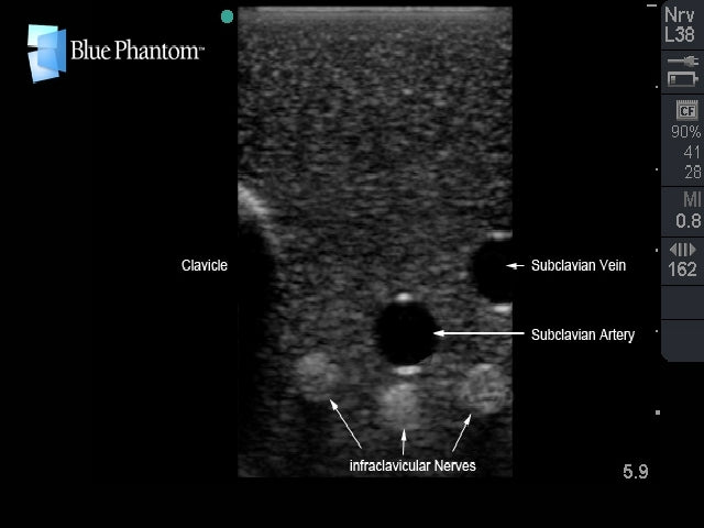 Blue Phantom Plexus brachialis-blockad samt ultraljudsvägledd CVK-inläggning med insättning av ersättningsvävnad