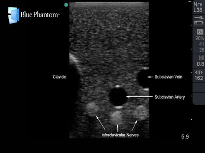 Blue Phantom Plexus brachialis-blockad samt ultraljudsvägledd CVK-inläggning med insättning av ersättningsvävnad