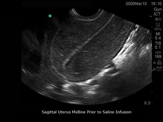 BluePhantom transvaginal ultraljudsträningsmodell för sonohysterografi och sonosalpingografi