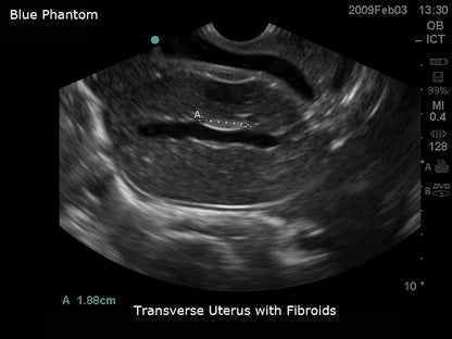 BluePhantom transvaginal ultraljudsträningsmodell för sonohysterografi och sonosalpingografi