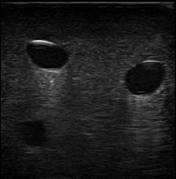BluePhantom PICC Ultraljudsträningsarm med IV & Arteriell Vaskulär Åtkomst