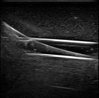 BluePhantom PICC Ultraljudsträningsarm med IV & Arteriell Vaskulär Åtkomst